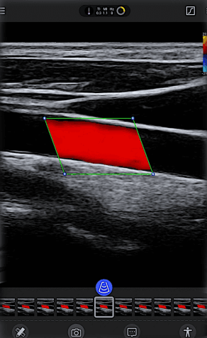 Thyroid Chroma