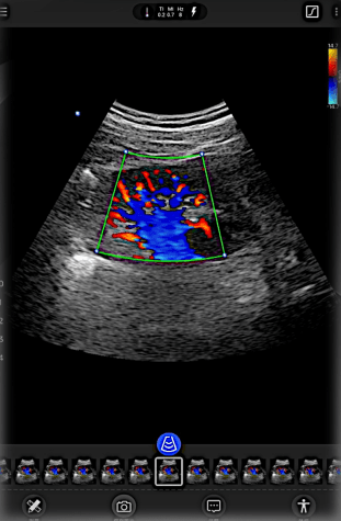 Thyroid with Trapezoid